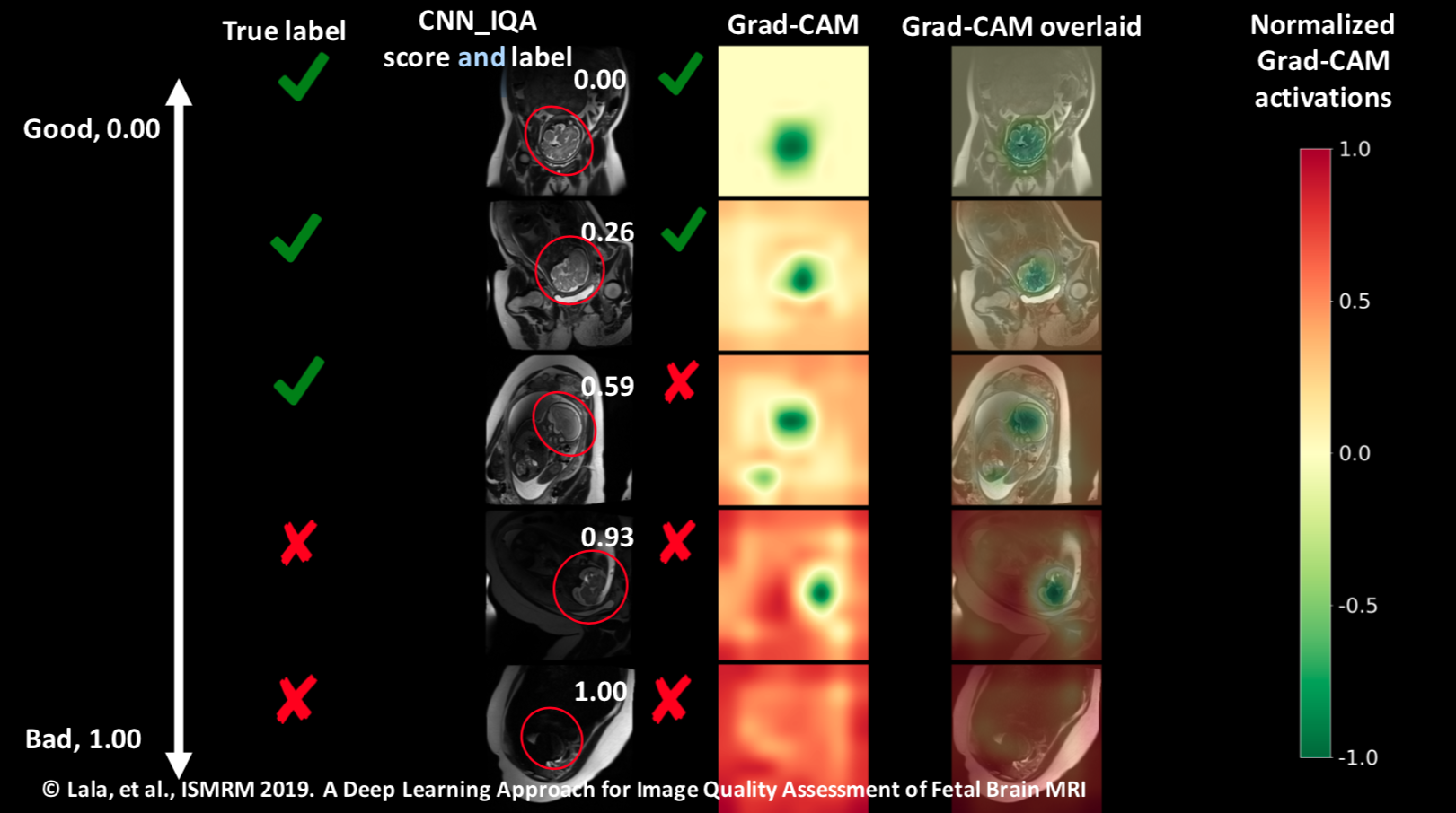 Grad-CAM detection of fetal brains in MRI scans.